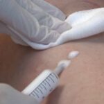 Scleromousse Dei Capillari