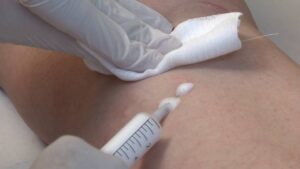 Scleromousse Dei Capillari