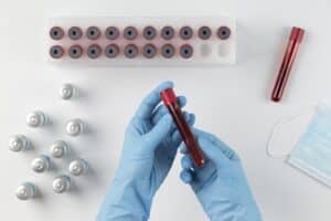 Azotemia alta nelle analisi del sangue: cosa vuol dire?