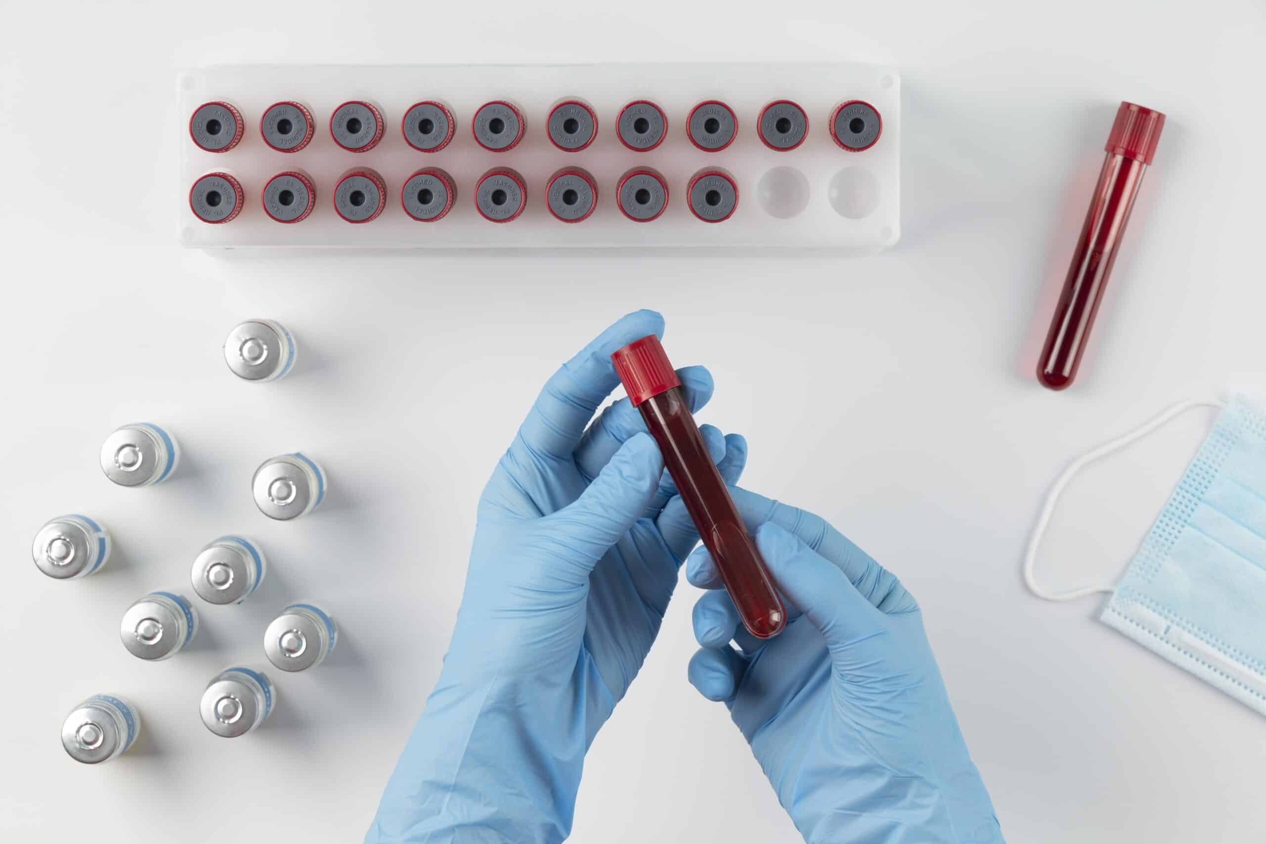 Azotemia alta nelle analisi del sangue: cosa vuol dire?